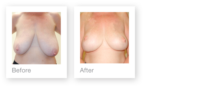 Breast reduction & mastopexy before and after surgery by David Oliver, Plastic Surgeon, Devon