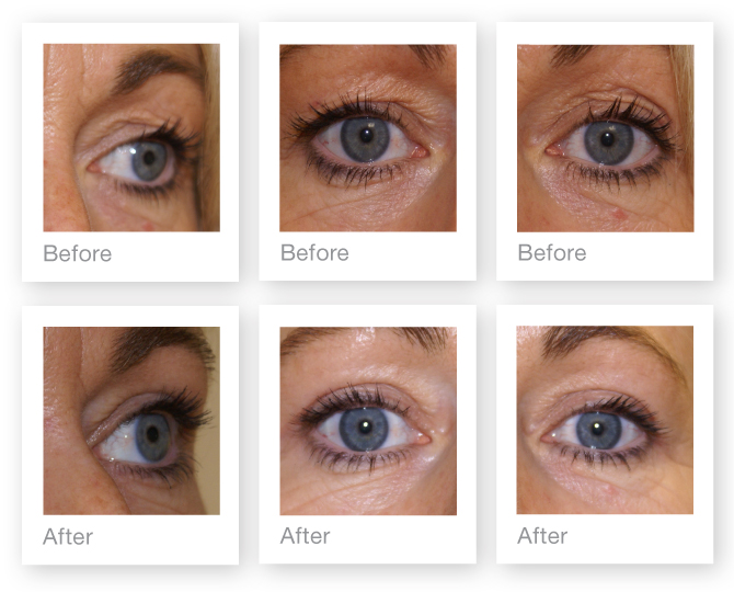 Eyelid (blepharoplasty) surgery by David Oliver, cosmetic surgeon before & after results