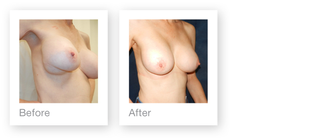 Breast Revisional Surgery of implants by David Oliver Cosmetic Surgeon in Devon