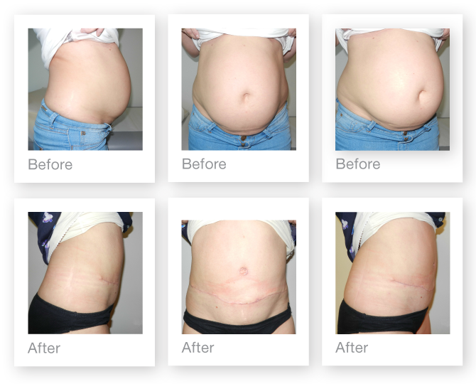 David Oliver Abdominoplasty surgery before & after July 2015