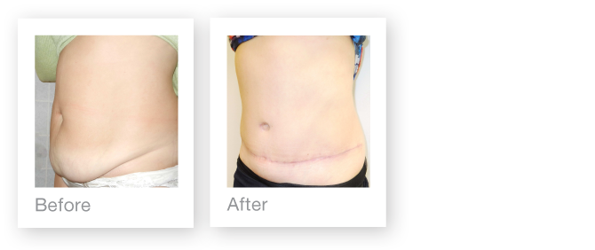 David Oliver Surgeon Abdominoplasty before & after surgery result