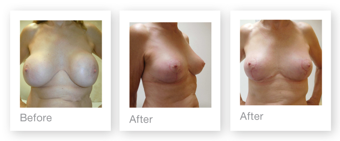 David Oliver breast surgery implant removal July 2016 before & after results
