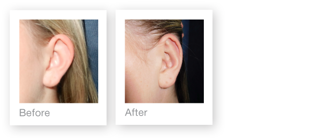 David Oliver Cosmetic Surgery Otoplasty ear surgery before & after
