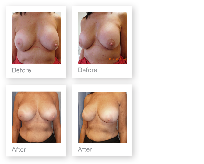 David Oliver cosmetic surgeon breast implant exchange surgery before & after