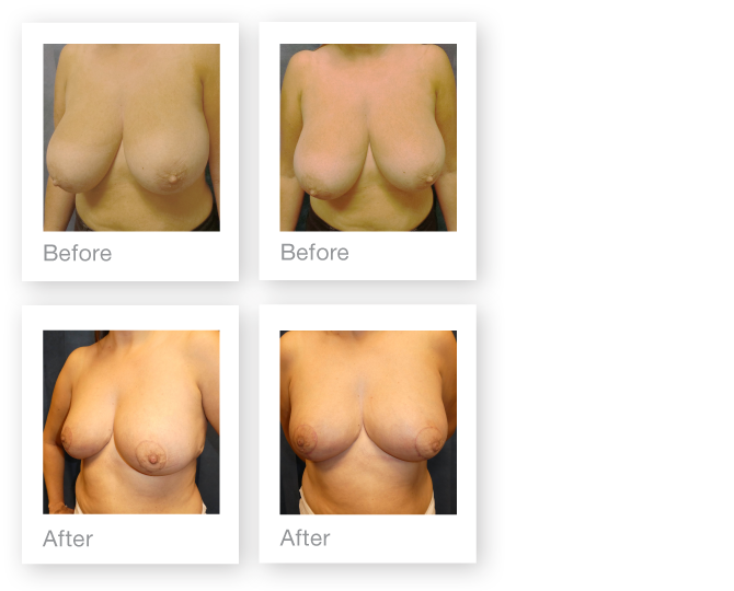 Breast reduction surgery before & after by David Oliver, Cosmetic surgery Devon - November 2016