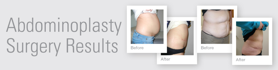 Abdominoplasty tummy tuck before after surgery results Exeter Torbay Devon Guernsey by David Oliver expert Breast Surgeon