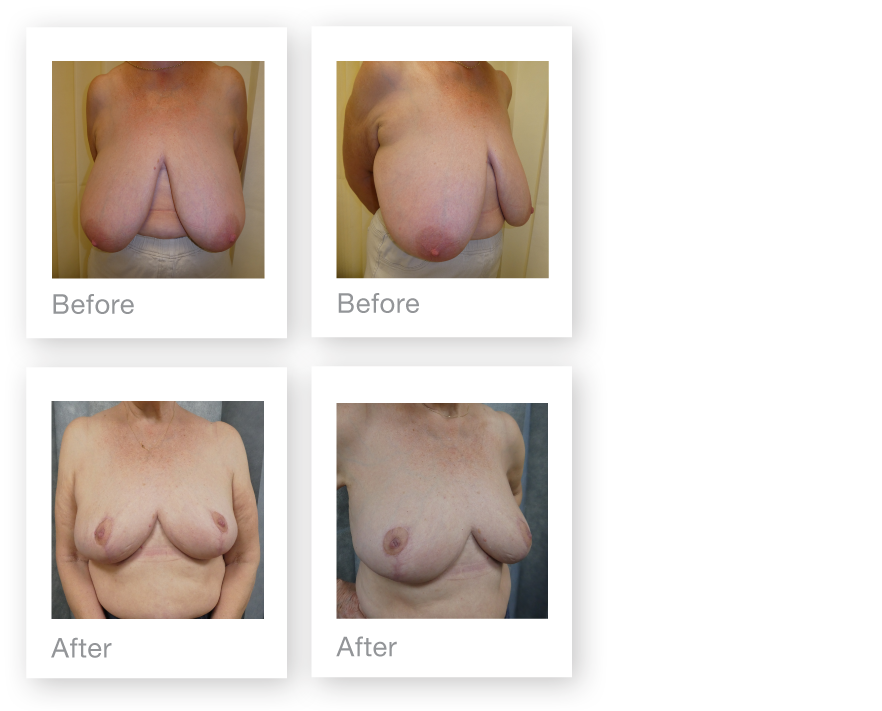 David Oliver Breast Reduction Surgery Before & after Results March 2019
