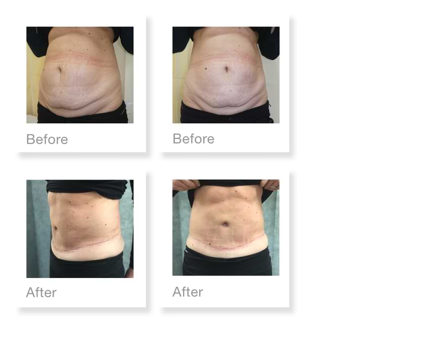 David Oliver Devon Abdominoplasty with Liposuction Surgery Before & After Result January 20920