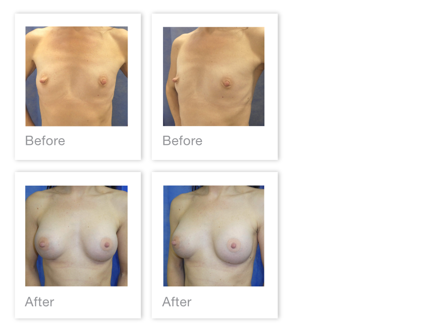 David Oliver Breast Augmentation Surgery Before After Exeter, Devon - January 2022