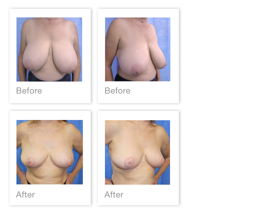 David Oliver Breast Reduction surgery before & after March 2022