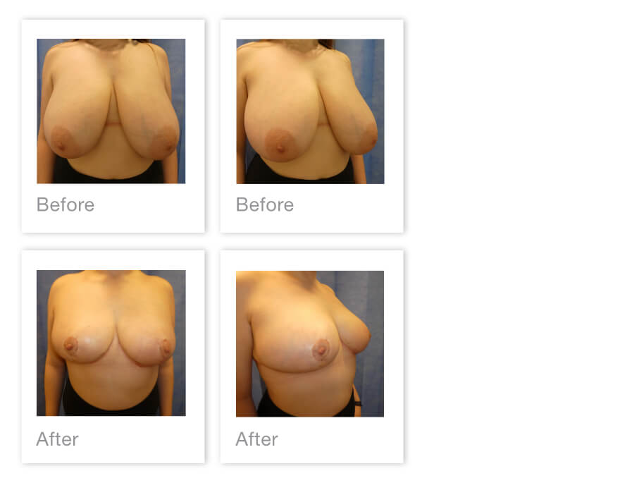 David Oliver Breast Reducton Surgery Before After Exeter, Devon - April 2022