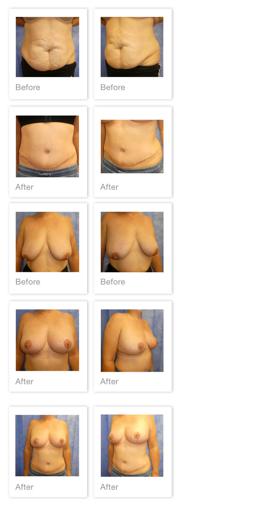 David Oliver Abdominoplasty & Mastopexy Surgery Before After Exeter, Devon - May 2022