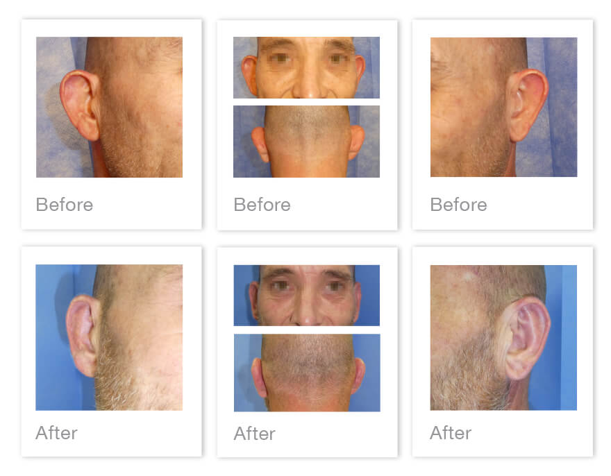 Otoplasty ear correction surgery before & After with David Oliver, Devon September 2022