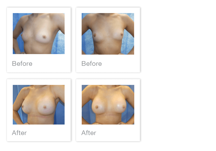Breast Augmentation surgery before & After with David Oliver Torquay, Devon, December 2022