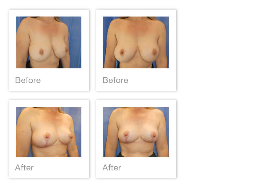 Breast Implant removal & mastopexy surgery before & After with David Oliver Exeter, Devon April 2023
