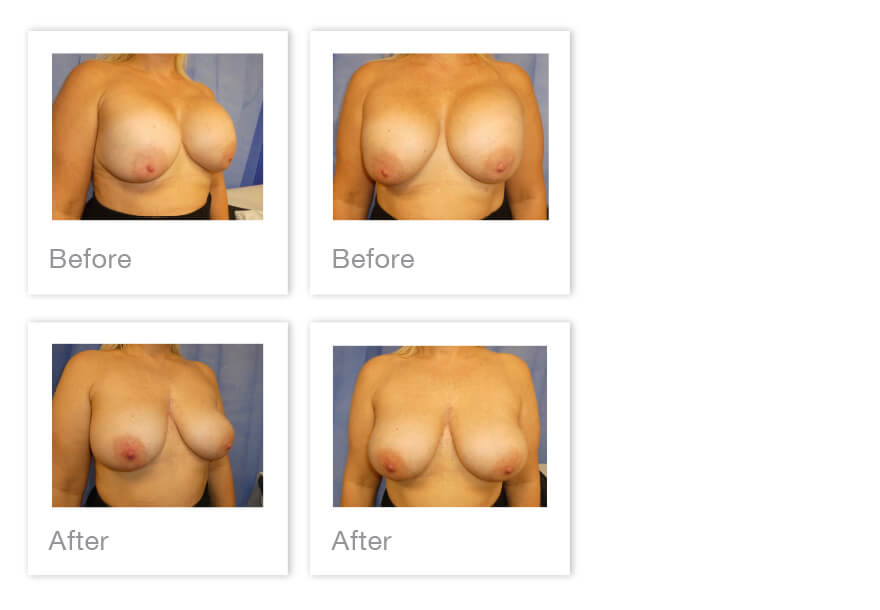 Breast Implant exchange surgery before & After with David Oliver Exeter, Devon May 2023