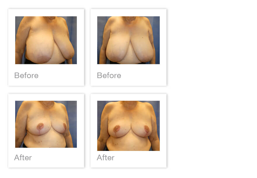 Breast reduction surgery with David Oliver Exeter, Devon November 2023 - before and after results
