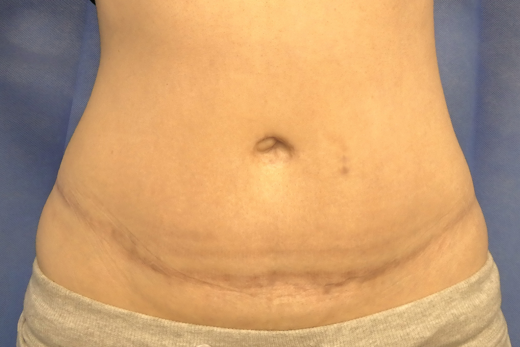 2025 June - Abdominoplasty with liposuction post surgery front results David Oliver