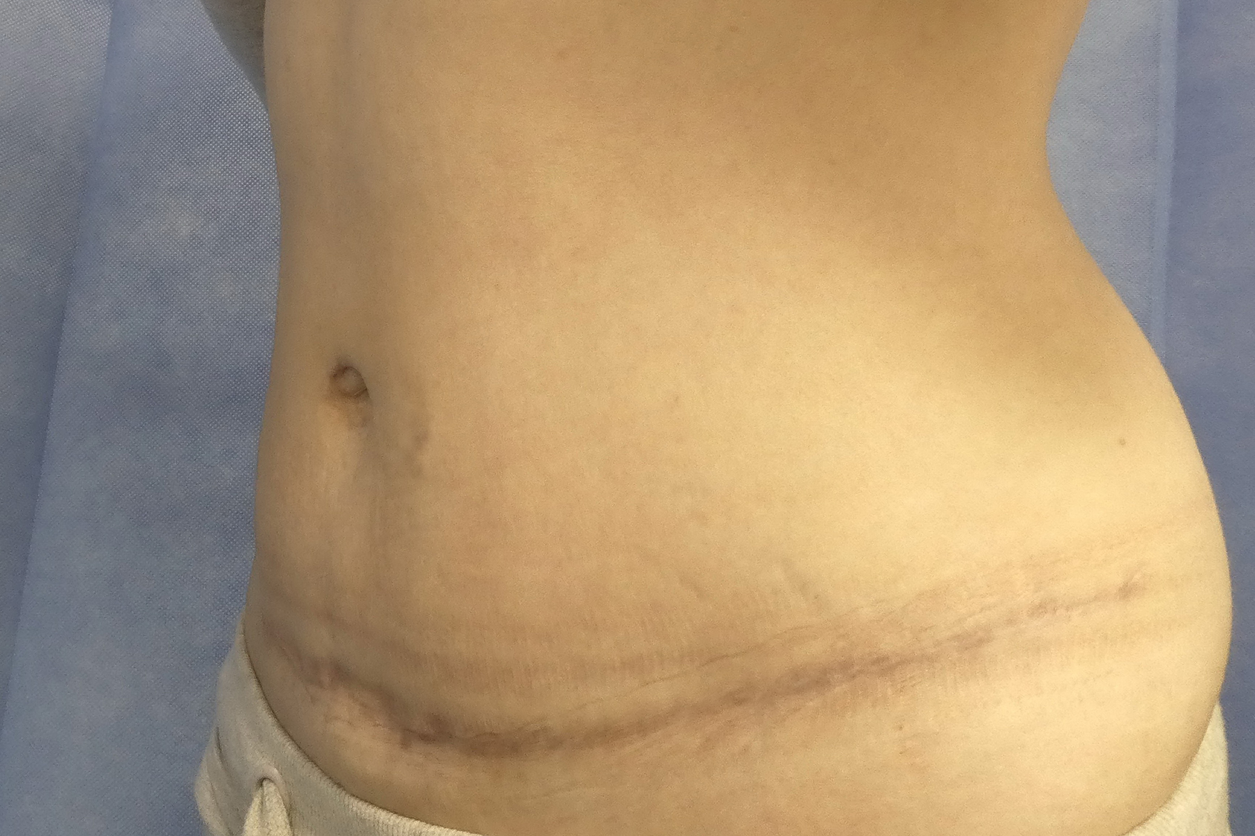 2025 June - Abdominoplasty with liposuction post surgery side result David Oliver