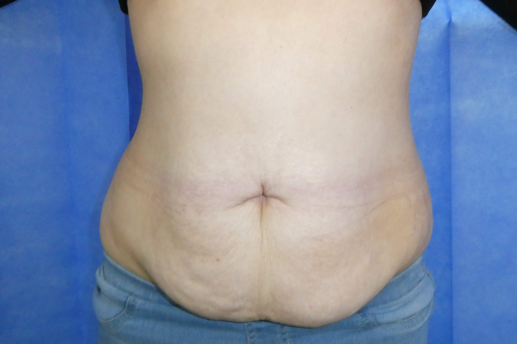 2025 June - Abdominoplasty with liposuction pre surgery front result David Oliver