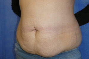 2025 June - Abdominoplasty with liposuction pre surgery side result David Oliver