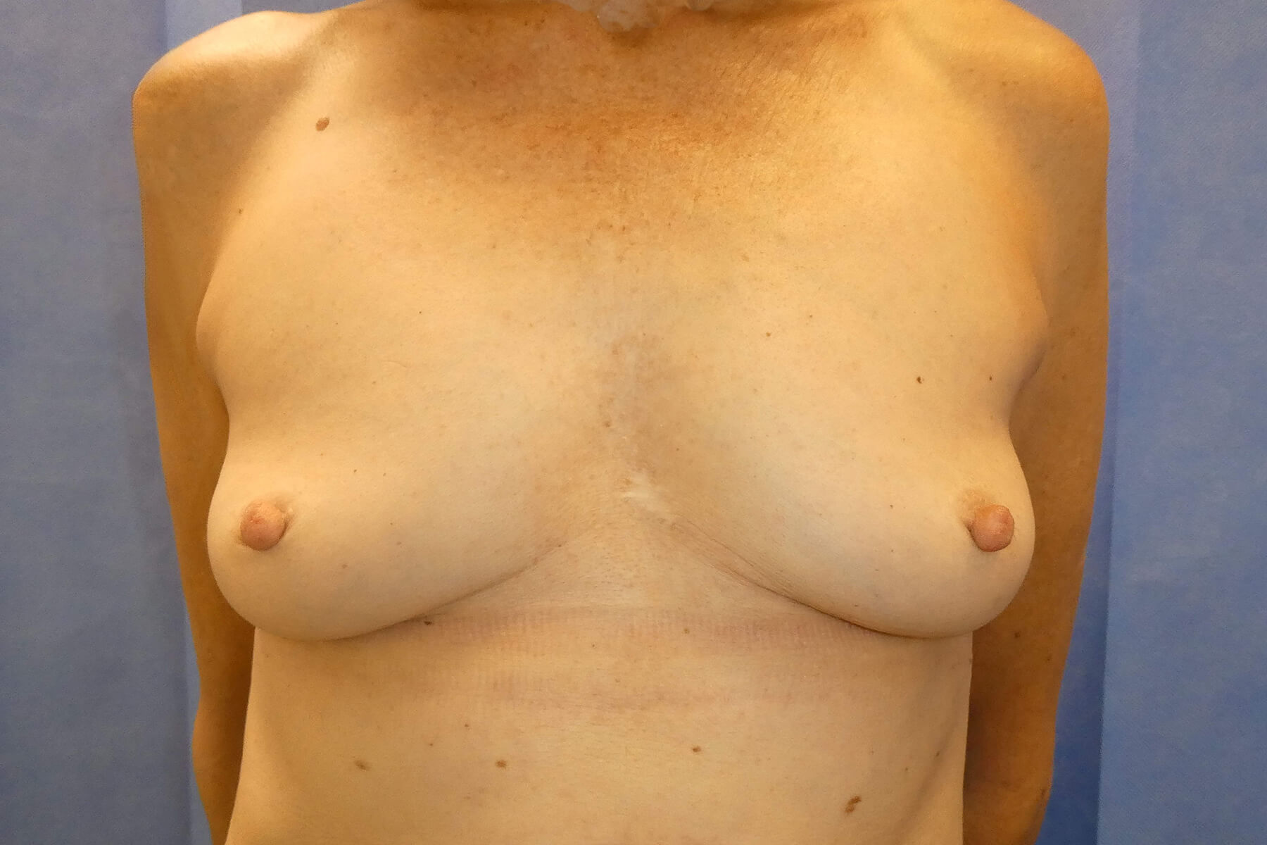 2025 September - Removal of Breast Implants post front David Oliver Devon
