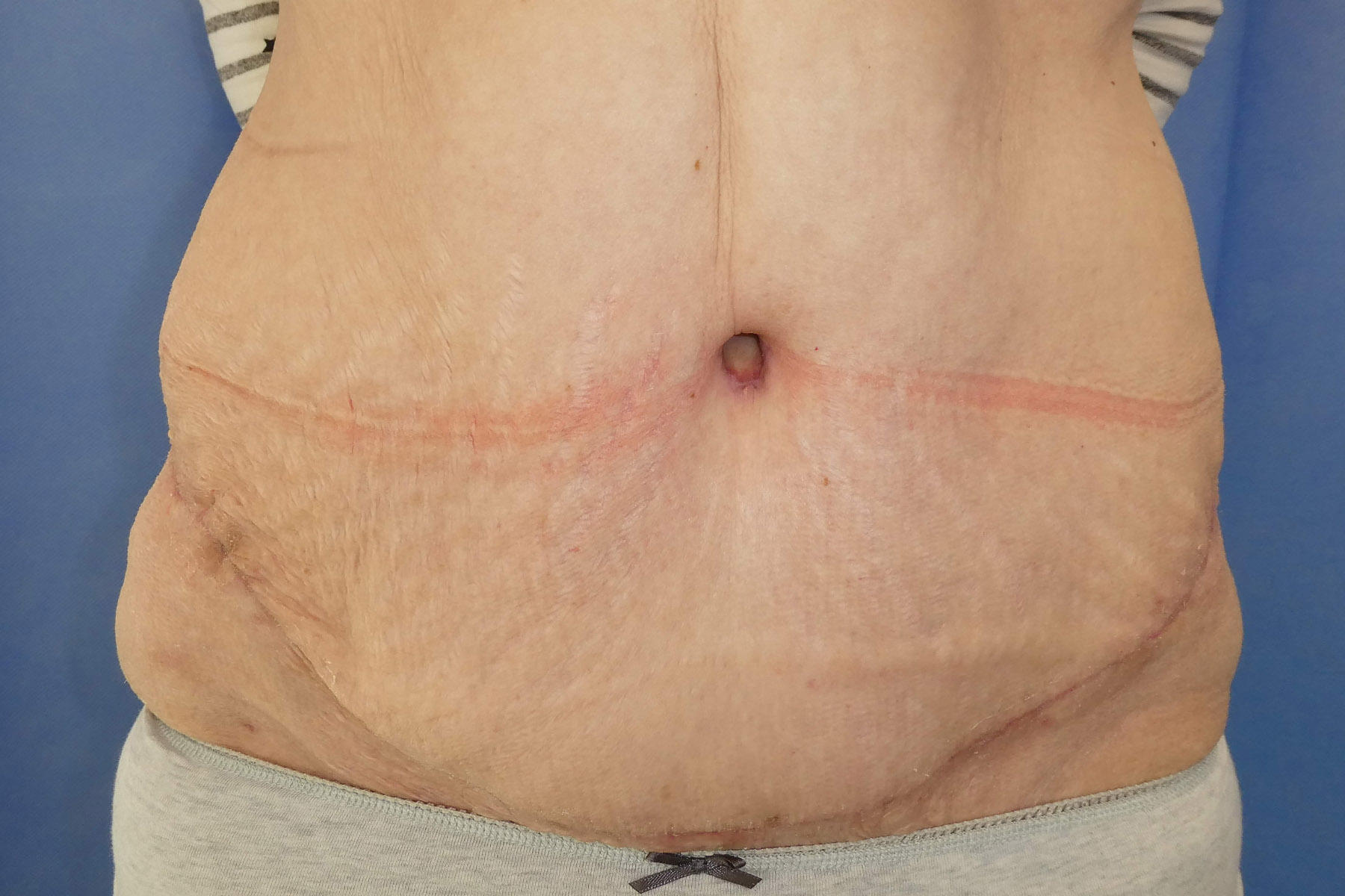 Dec 2025 - Abdominoplasty front view post surgery result David Oliver Cosmetic Surgery