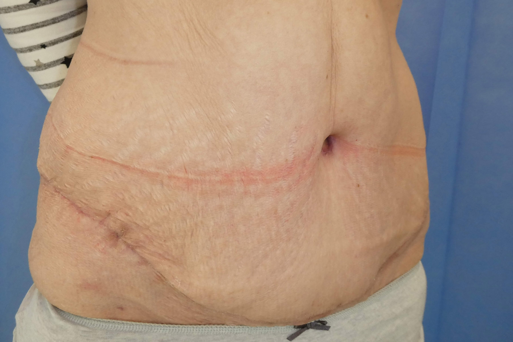 Dec 2025 - Abdominoplasty side view post surgery result David Oliver Cosmetic Surgery