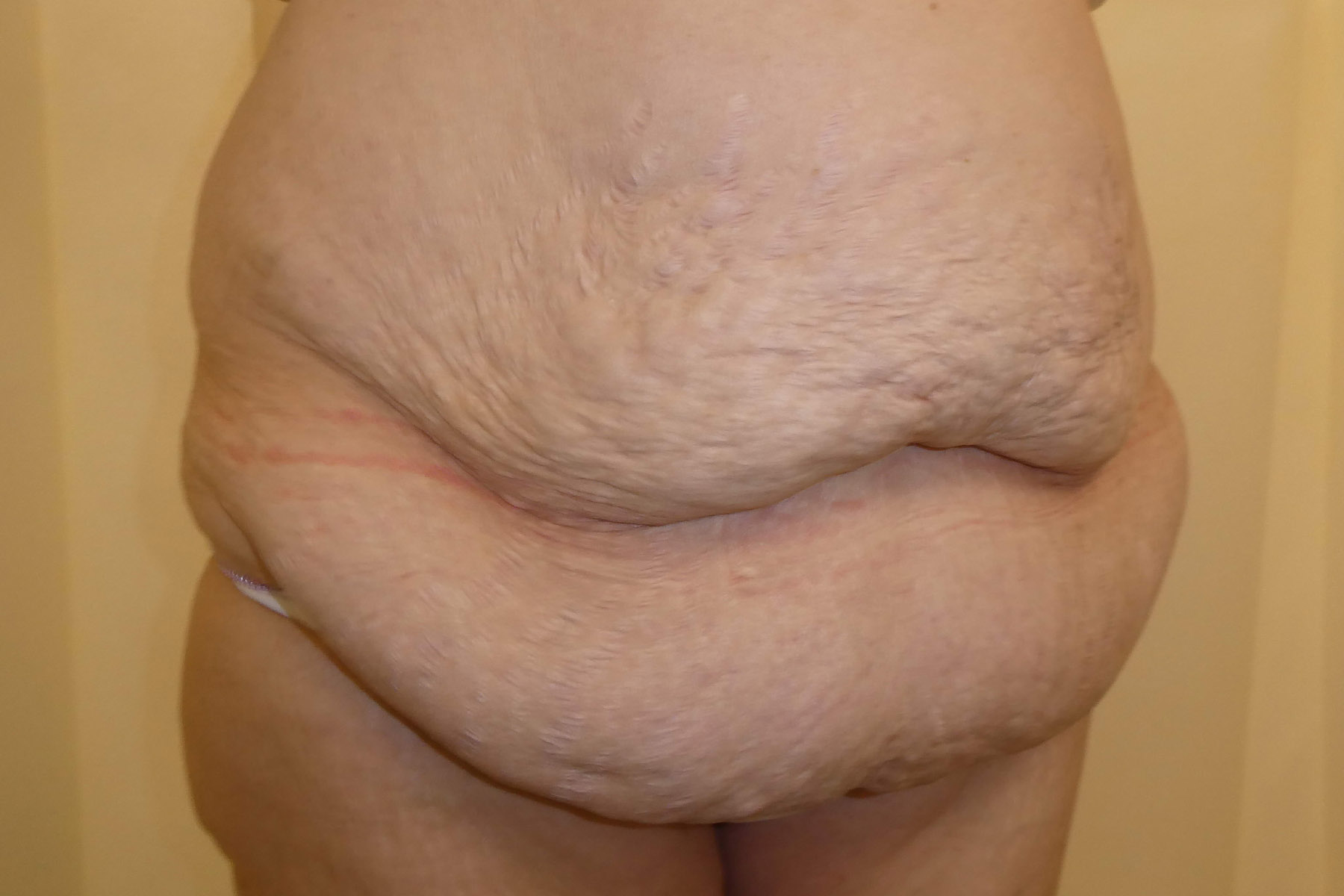 Dec 2025 - Abdominoplasty side view pre surgery David Oliver Cosmetic Surgery