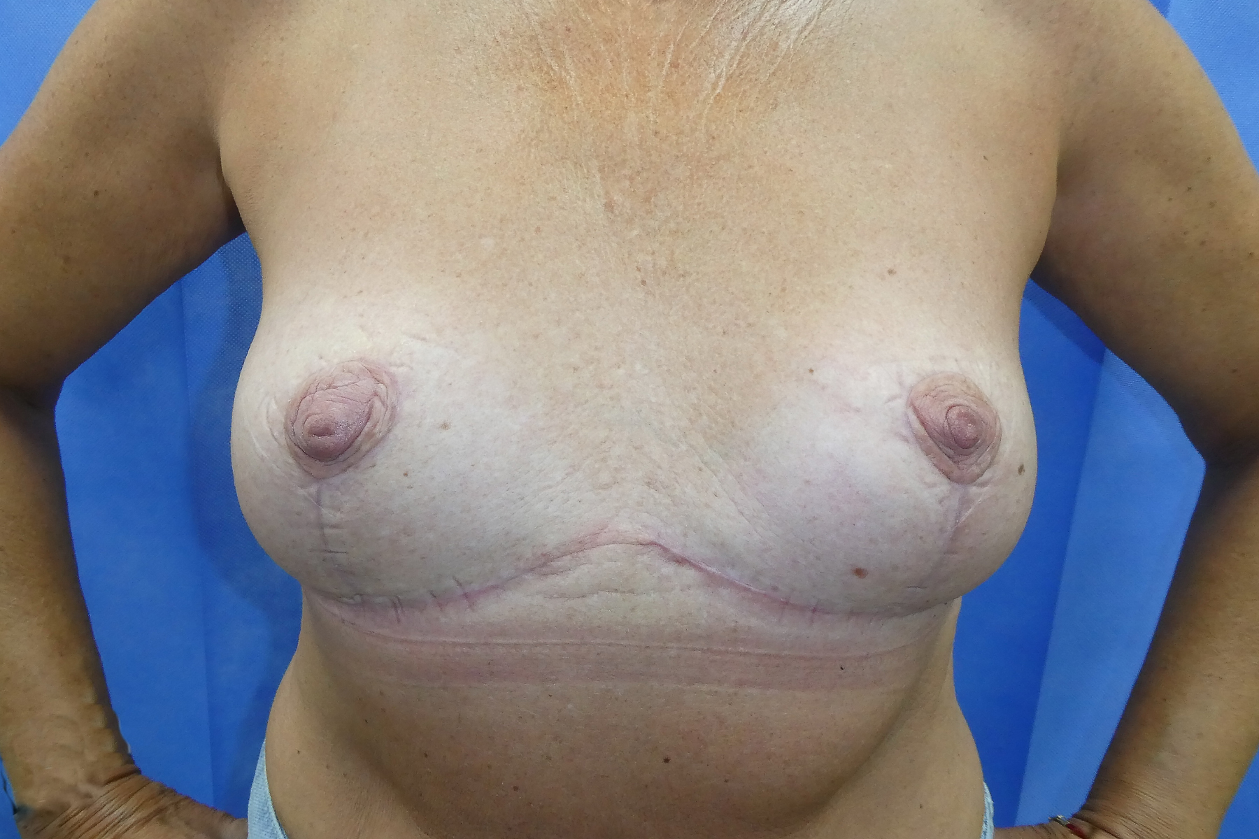 2026 July - Breast implant removal and Mastopexy Breast Uplift post surgery front result David Oliver Exeter