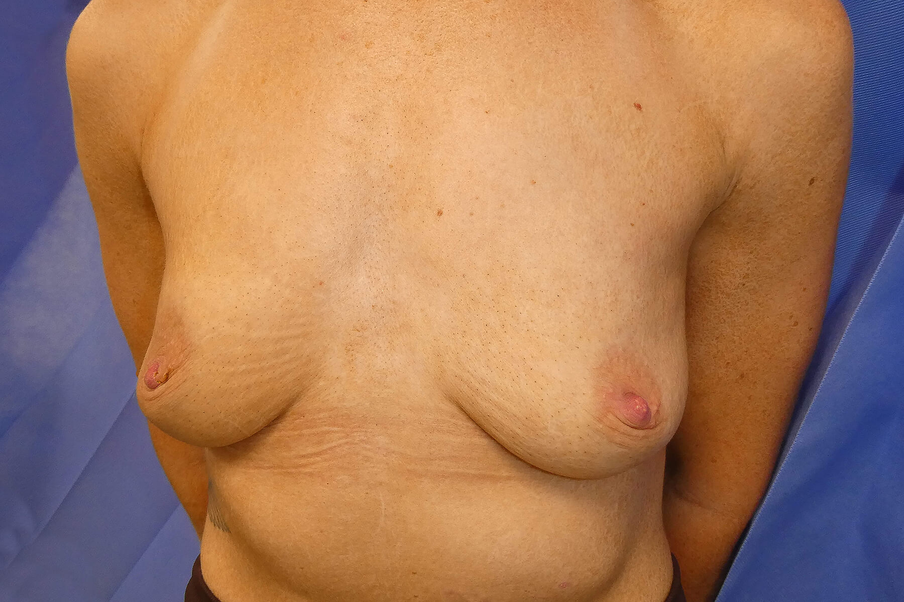 2026 August - Bilateral Breast Augmentation high profile implants surgery pre side David Oliver Devon