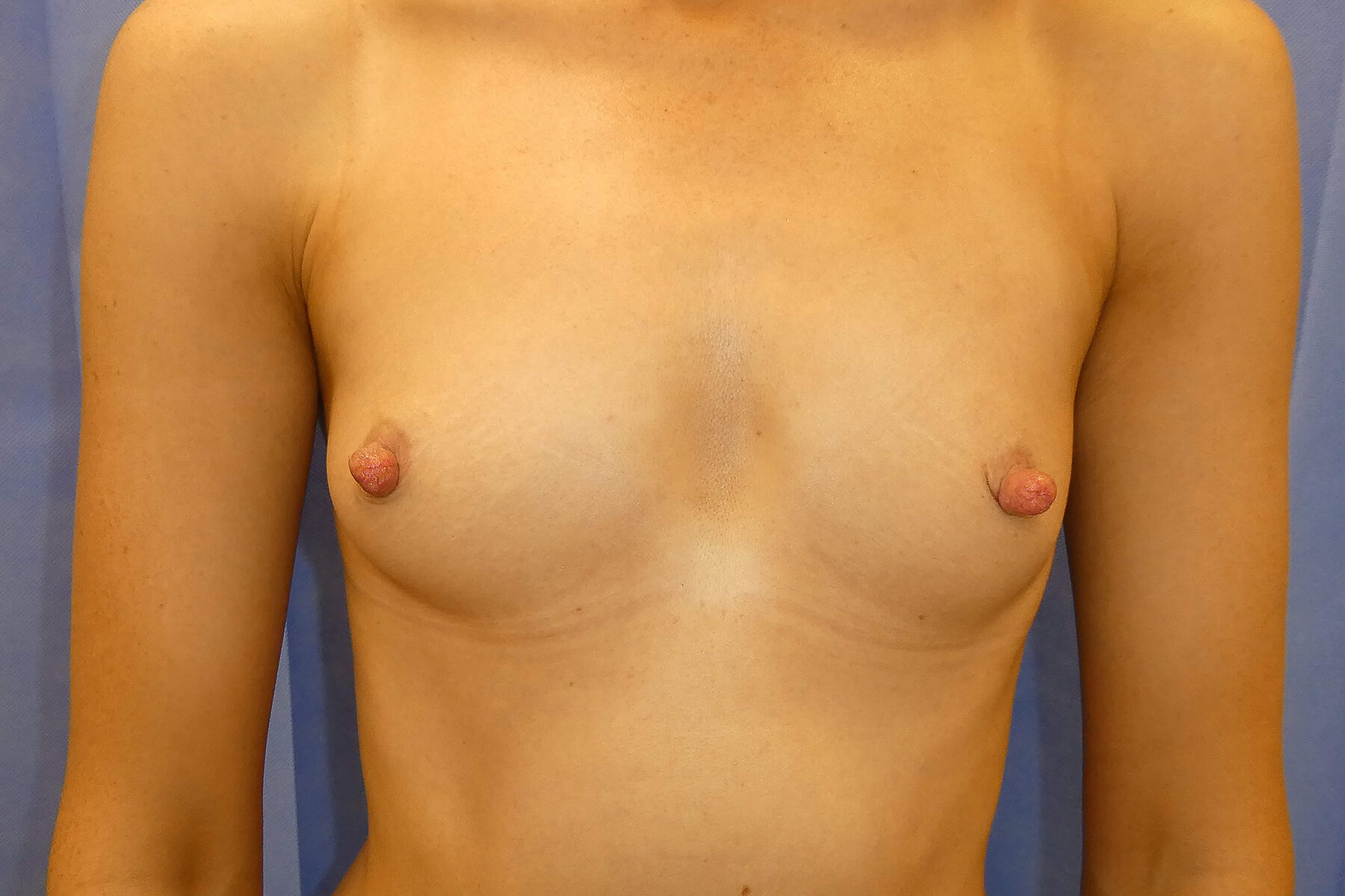 2026 August - Bilateral Breast Augmentation surgery pre front David Oliver Exeter, Devon